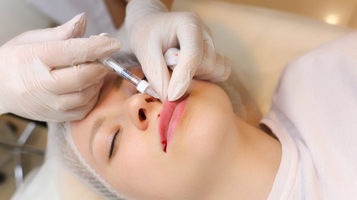 are-hyaluronic-acid-needleless-lip-fillers-safe-featured